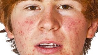 Common Acne Mistakes - Not Allowing Enough Time for Treatments