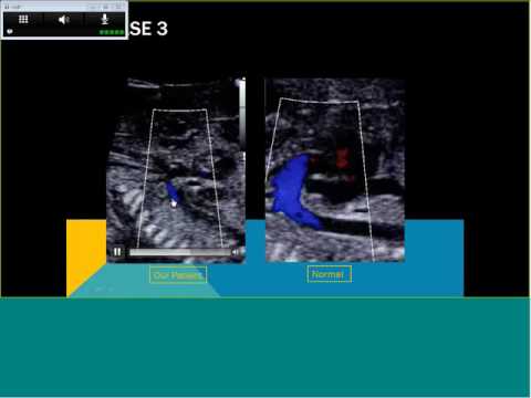 Topics in Fetal Medicine: Left-sided Obstructive Lesions in the Fetal Heart