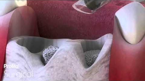 Dental Implants | Bone Grafting