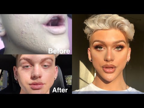Secret To Getting Rid Of Texture Small Acne Bumps Youtube