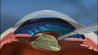 Cataract surgery with Laser Lensx™