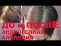 Женское облысение. Андрогенная алопеция. Как востановить красивые волосы