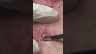 Deep Blackhead Extraction: Soft Pop