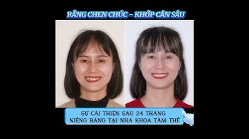 Case thực tế điều trị răng chen chúc, khớp cắn sâu tại Nha khoa Tâm Thế #nhakhoadalat #niengrang