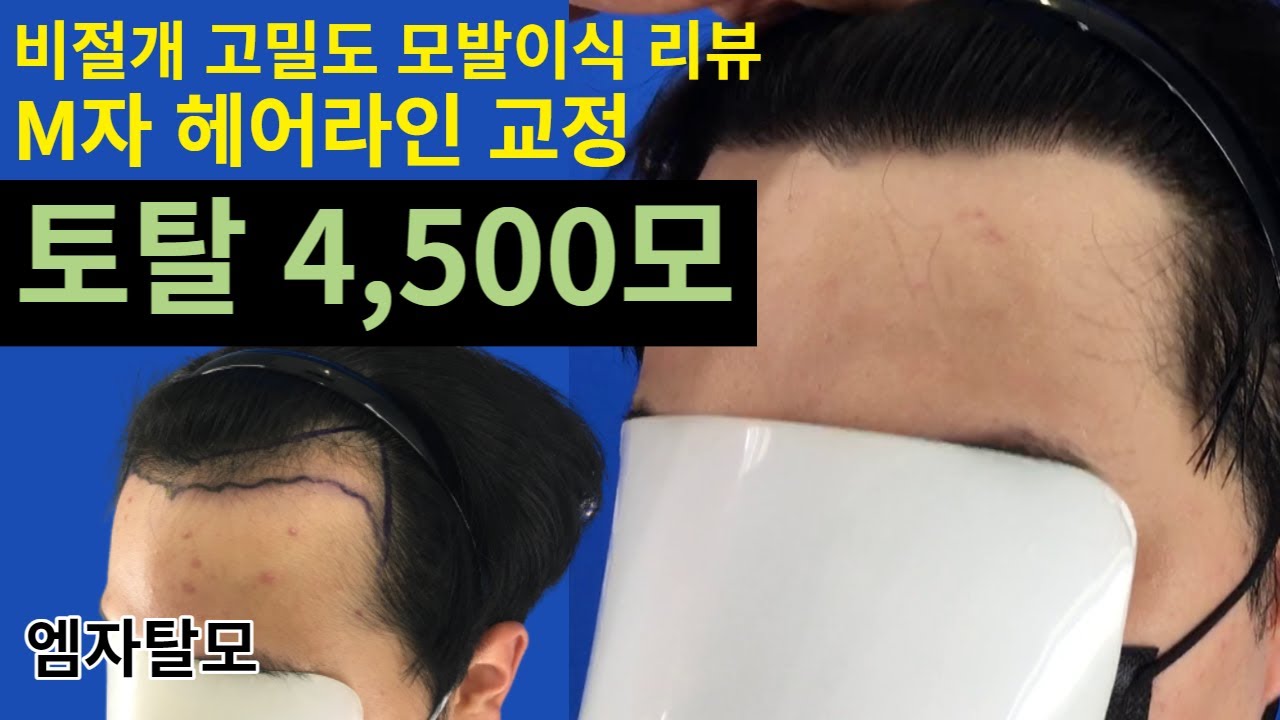 남자들이 M자탈모 헤어라인 모발이식을 하는 이유. 영상에 해답이 있습니다!