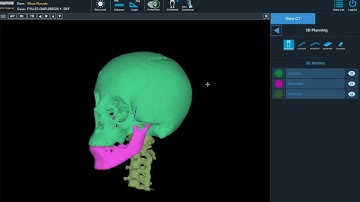 AlgoSurg AI for speeding up Maxillofacial Surgical 3D printing Workflow by 10X