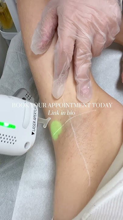 Bye Bye Press Ons Removal System Laser Hair Removal with Lutronic Clarity II Bye Bye razor bumps! - YouTube