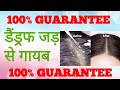 Dandruff treatment at home  permanent dandruff solution       