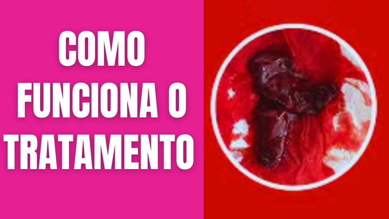 🔴MENSTRUAÇÃO COM PEDAÇOS OU COÁGULOS DE SANGUE - COMO FUNCIONA O ...
