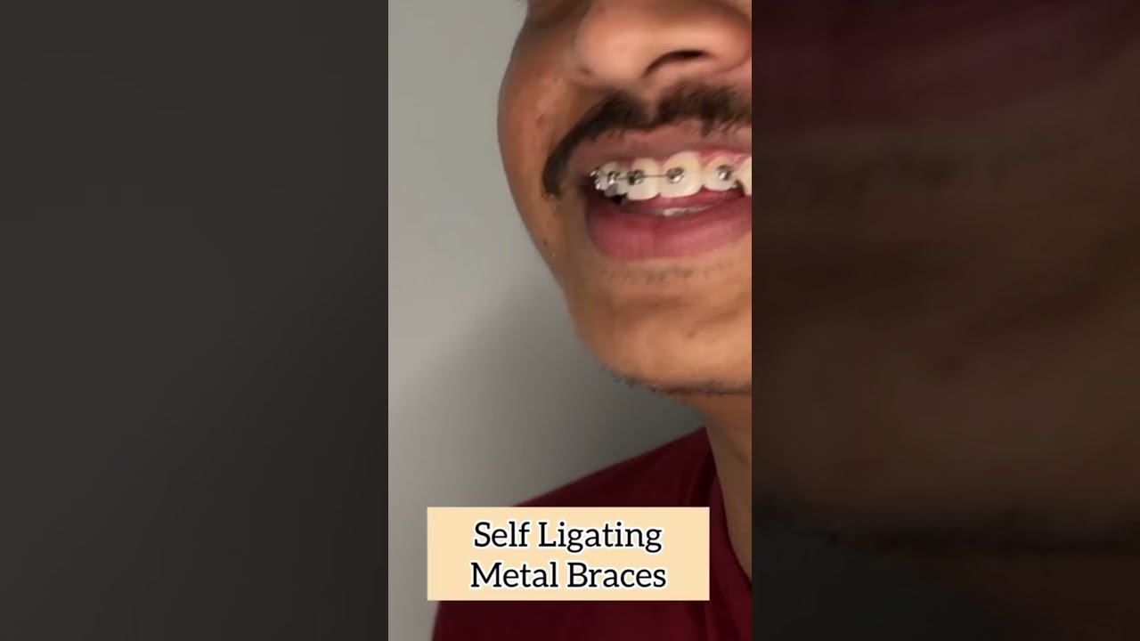 Trisa Dental Solutions - Metal Braces