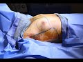 Gynecomastia Male Breast Reduction with Liposuction for Man Boobs