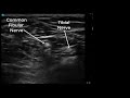 Ultrasound of the Popliteal fossa