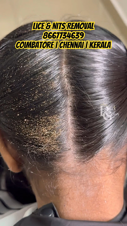 Lice treatment in Chennai/lice treatment in parlour/lice treatment clinic/lice eggs in hair/lice