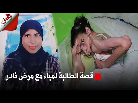 فيديو: تم التصيد فتاة مصابة بمرض نادر بسبب مظهرها