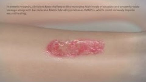 3M™ Kerramax Care™ Super-Absorbent Dressings Mode of Action and Application Video