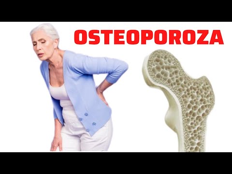Video: Osteoporoz üçün prolia qəbul etməliyəmmi?