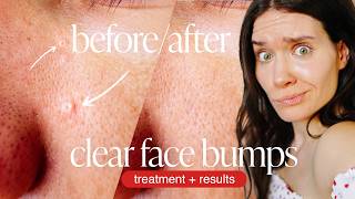 BURNING OFF WARTS AT HOME - Warts Sebaceous Hyperplasia Removal - DIY WART REMOVAL