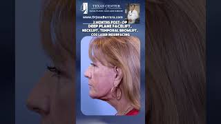 Deep Plane Facelift, Neck Lift, Temporal Brow Lift, and CO2 Laser Resurfacing. 💫