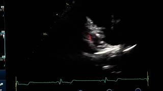 Pulmonary view in PLAX