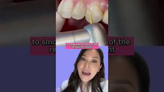 How Cement Is Removed After Braces Brackets Are Taken Off