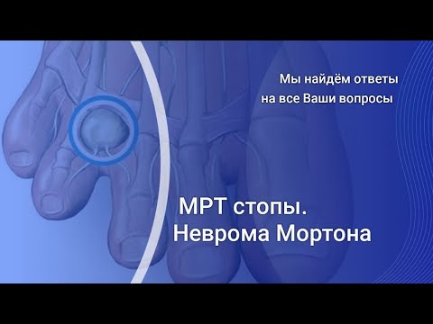 МРТ при невроме Мортона