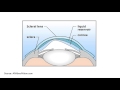 The Benefits of Scleral Contact Lenses