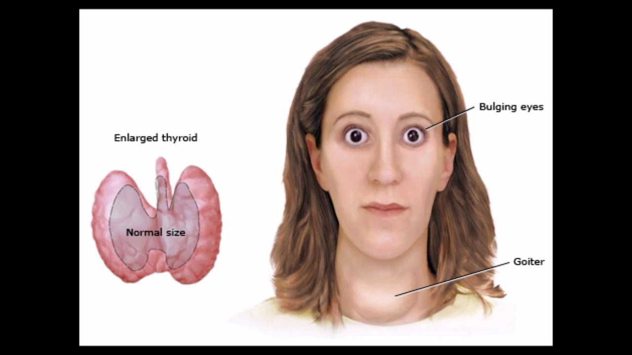 Почему увеличивается глаза. Щитовидная железа базедова болезнь. Диффузный токсический зоб( болезнь Грейвса-базедова). Гиперфункция щитовидной железы зоб базедова болезнь. Тиреотоксикоз щитовидной железы зоб.