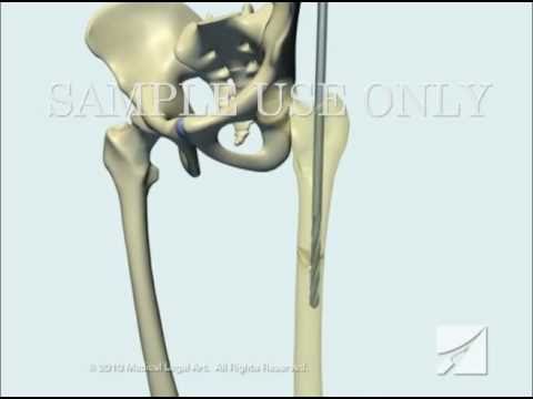 Femoral shaft fracture: Open femoral fracture bone defect treated with the  Precice Bone Transport Nail (Nuvasive) Surgical Technique - OrthOracle