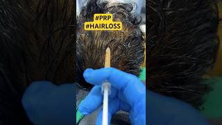 prp hairloss  baldness alopecia hair hairtransplant drpranilmore ytshorts shorts viral