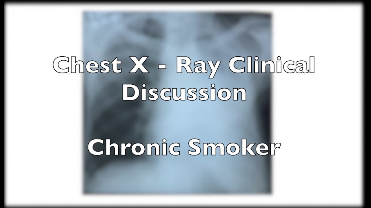 Chest XRay discussion 3. Smoker presents with Chronic Cough. YouTube
