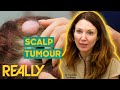 Dr. Emma Removes Tumours Growing On Woman’s Scalp | The Bad Skin Clinic