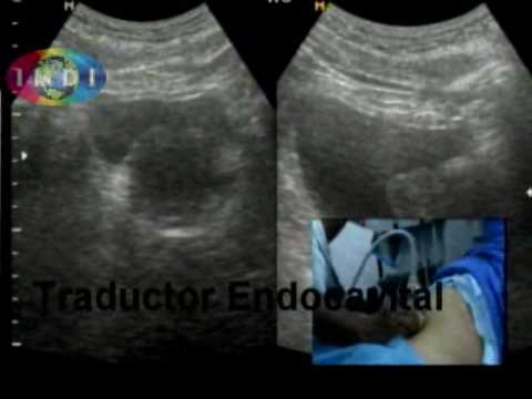 Vídeo: Ultrasonido De Próstata: Procedimiento, Propósito, Resultados Y Más