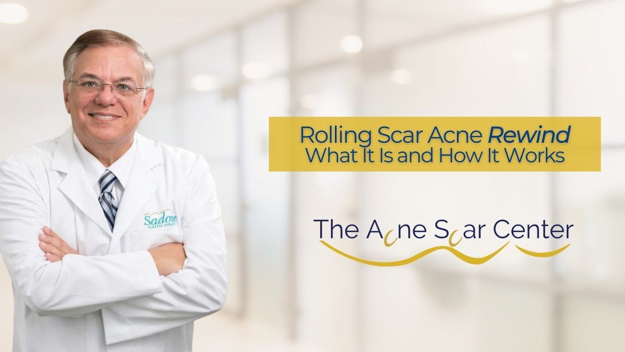 Most Effective Rolling Acne Scar Treatment Rolling Scar Rewind YouTube