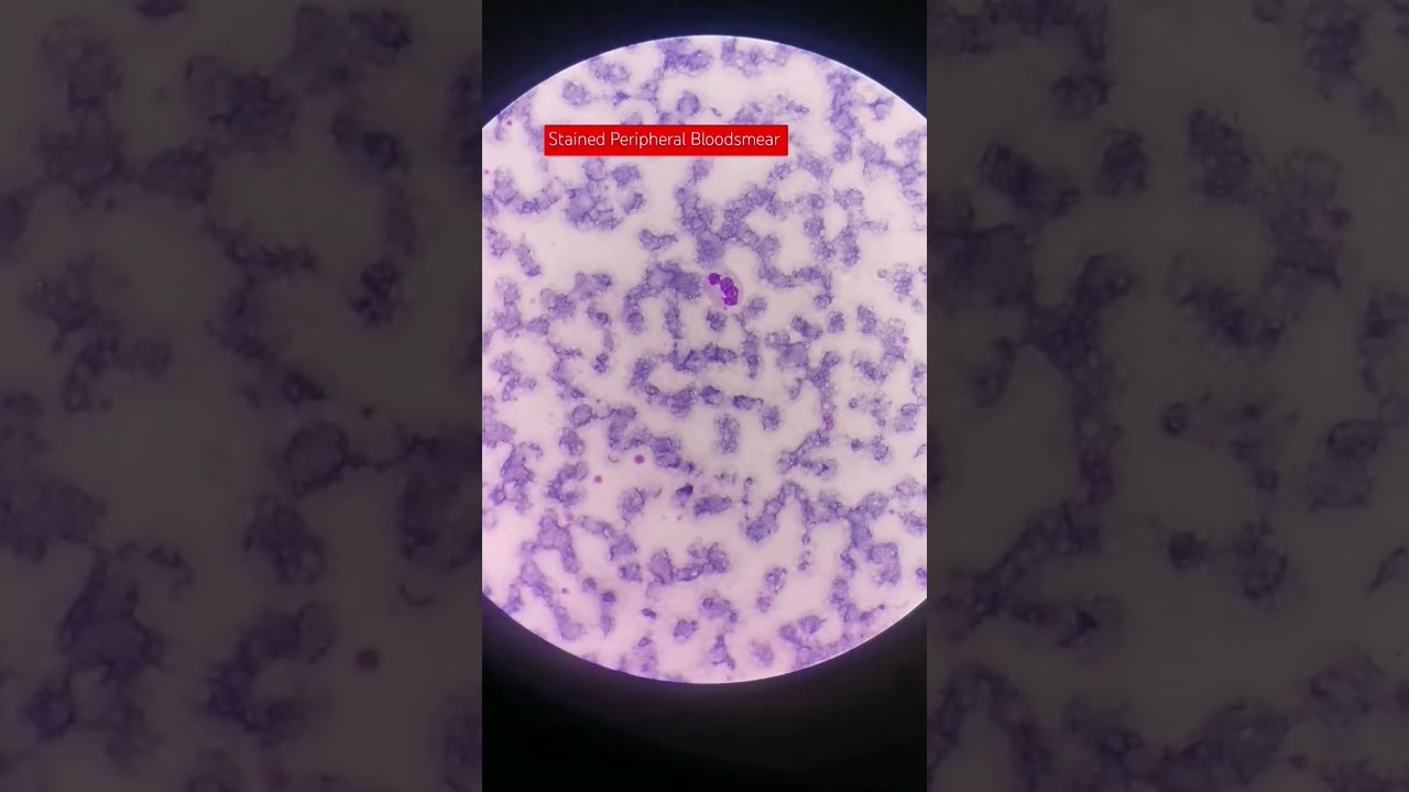 Stained Peripheral Bloodsmear under the microscope 