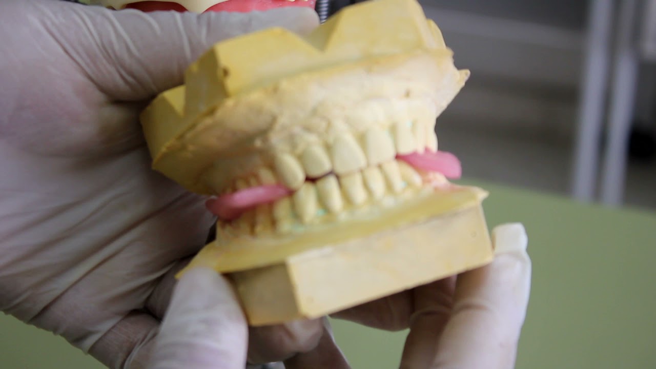 Elaboración de registro de oclusión con cera y silicona