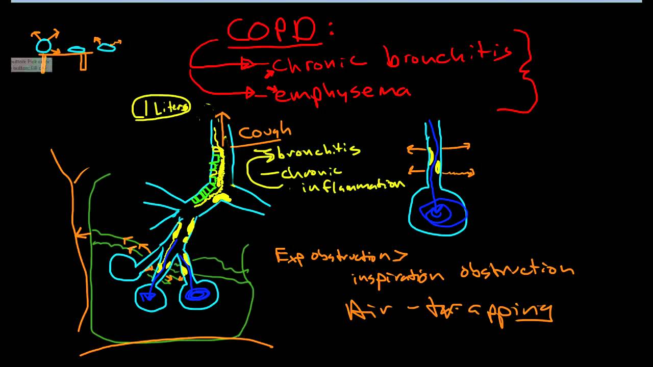 Pathogenesis Of Copd Flow Chart