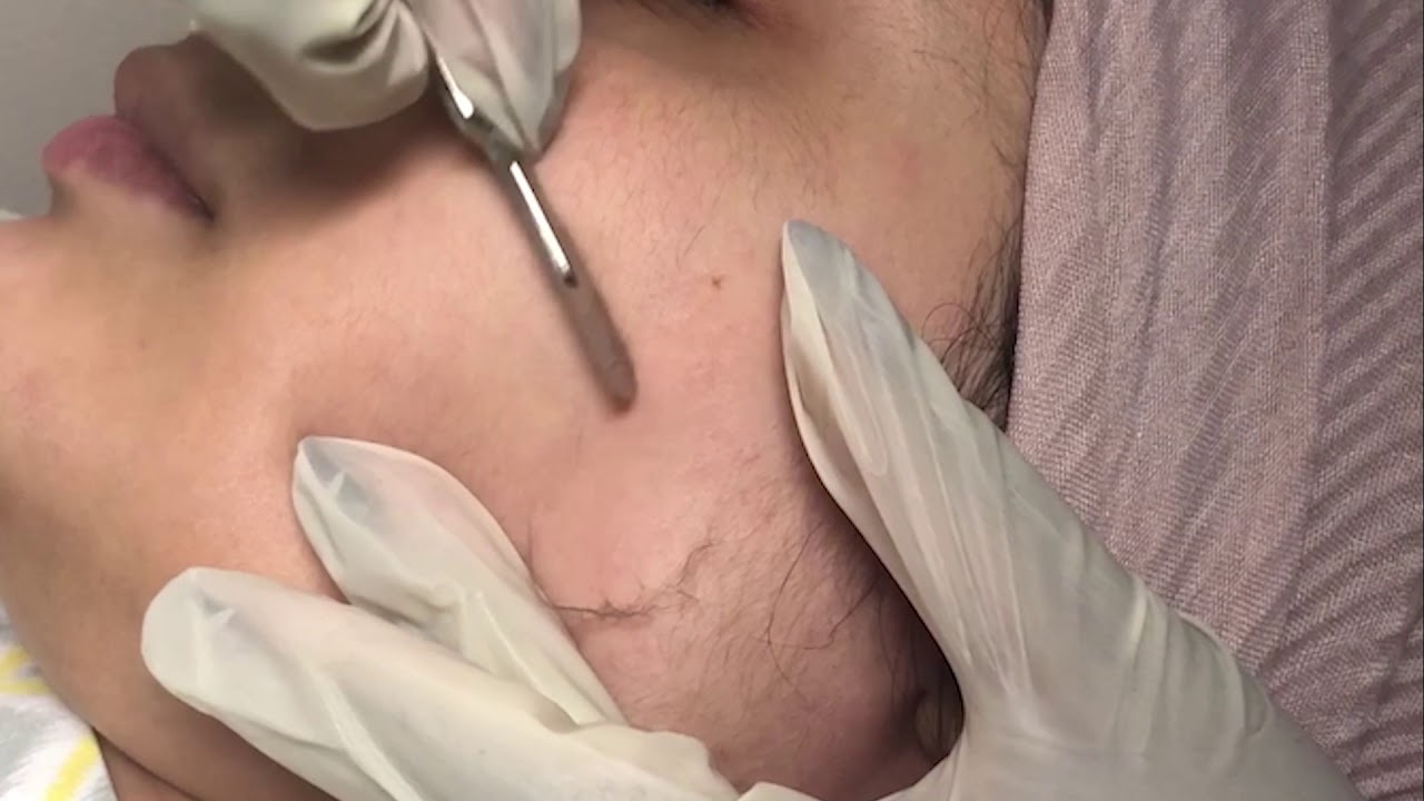 Dermaplaning Treatment at Lakeview Dermatology