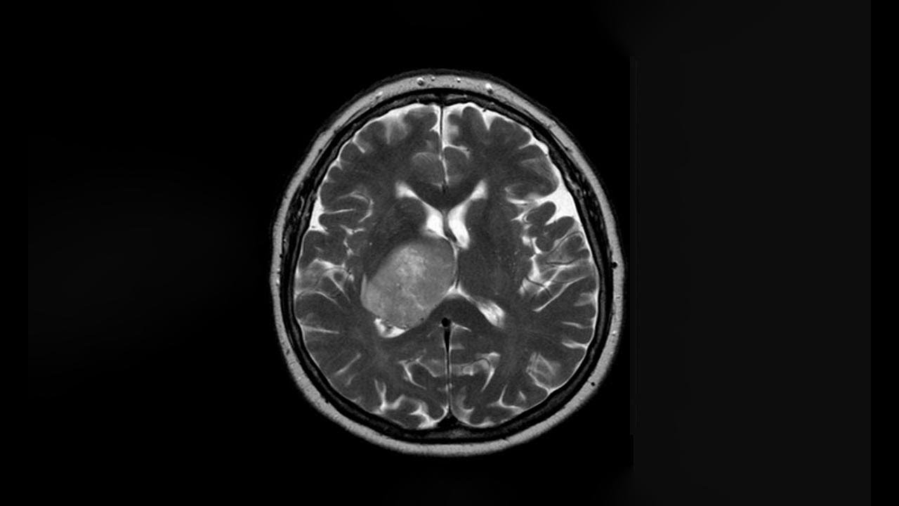 La coenzima Q10 y sus efectos en el glioblastoma.