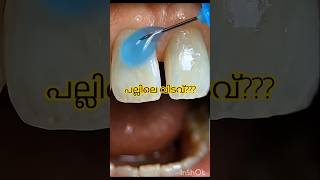 പല്ലിലെ വിടവ് മാറ്റാം / #pallilkambi #pallilkambiidunnath #braces #palludr #viral #shorts #teethgap