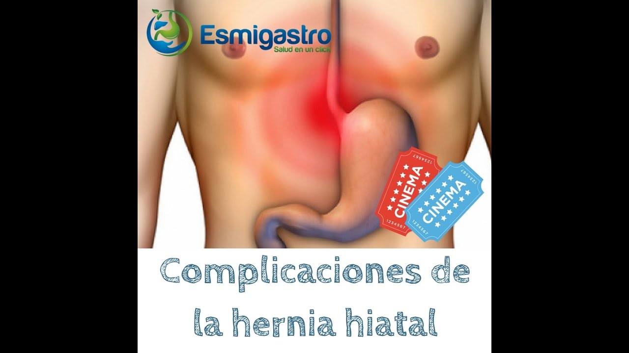 Complicaciones de la Hernia Hiatal saludos amigos dvd