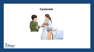 Cystocele