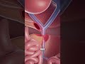 Surgical Procedure for Pancreaticojejunal Anastomosis #foryou#health