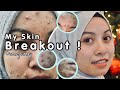My Story Acne Journey | 400 Hari Perubahan ✨ #skinbreakout #pcos