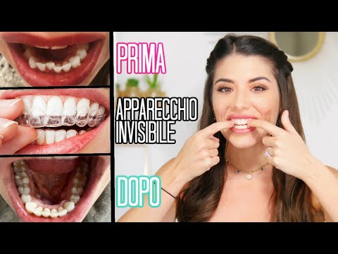 ADDIO DENTI STORTI! 10 COSE CHE DEVI SAPERE SULL&rsquo; APPARECCHIO INVISIBILE! | Adriana Spink