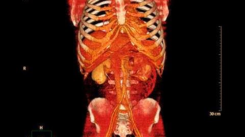 Abdomen Volume Rendering