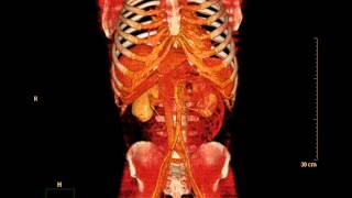 Abdomen Volume Rendering