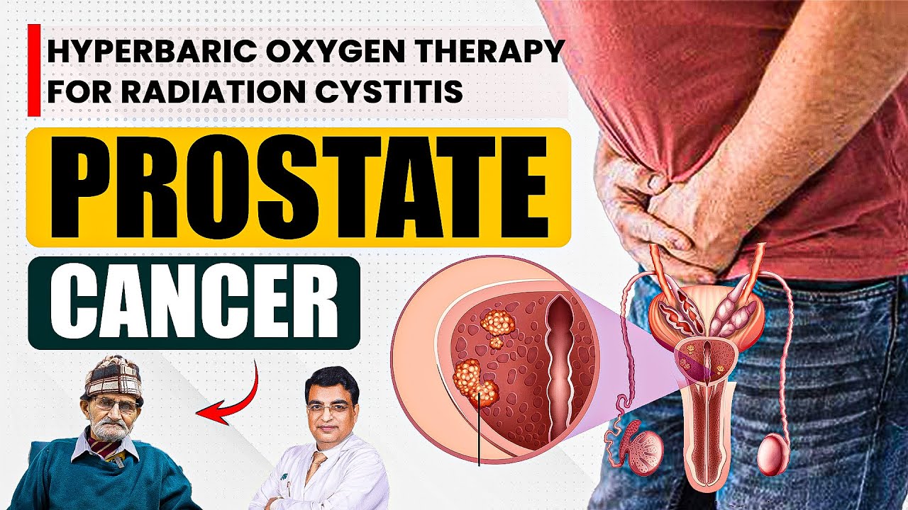 How Hyperbaric Oxygen Therapy Saved a Prostate Cancer Patient! | Treatment for Radiation Cystitis