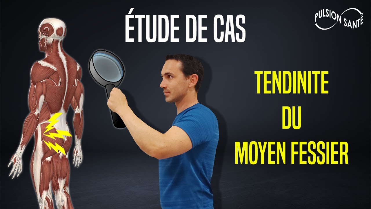 TENDINITE DU MOYEN FESSIER : CAS CLINIQUE N°3