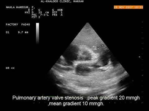 Pulmonary Artery Stenosis Echo