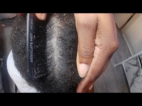 Just relax and watch this dandruff scratch